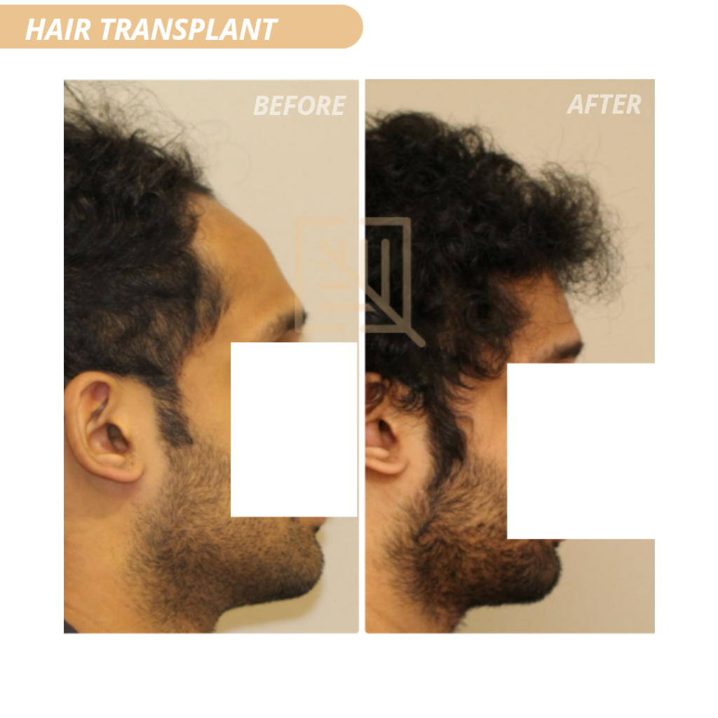 DermaVue Skin  Plastic Surgery Lasers  Hair Transplant  Hair  Transplantation Clinic in Trivandrum