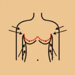 Br-east-Reduction-liposuction