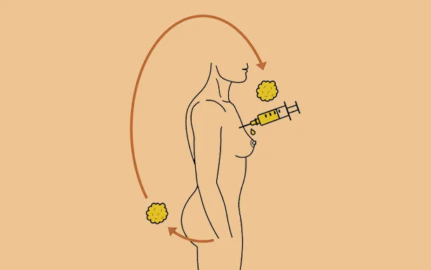 Br-east-fat-injection
