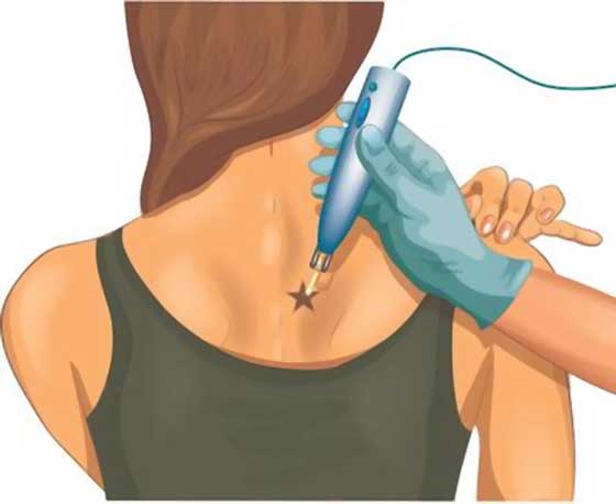 Permanent Tattoo Removal Surgery in Kerala - Cosmetiq Clinic