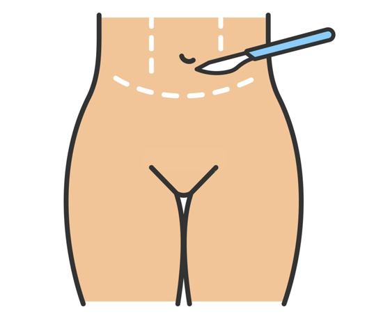 Tummy Tuck India, Abdominoplasty Thrissur, Body Procedures Kerala