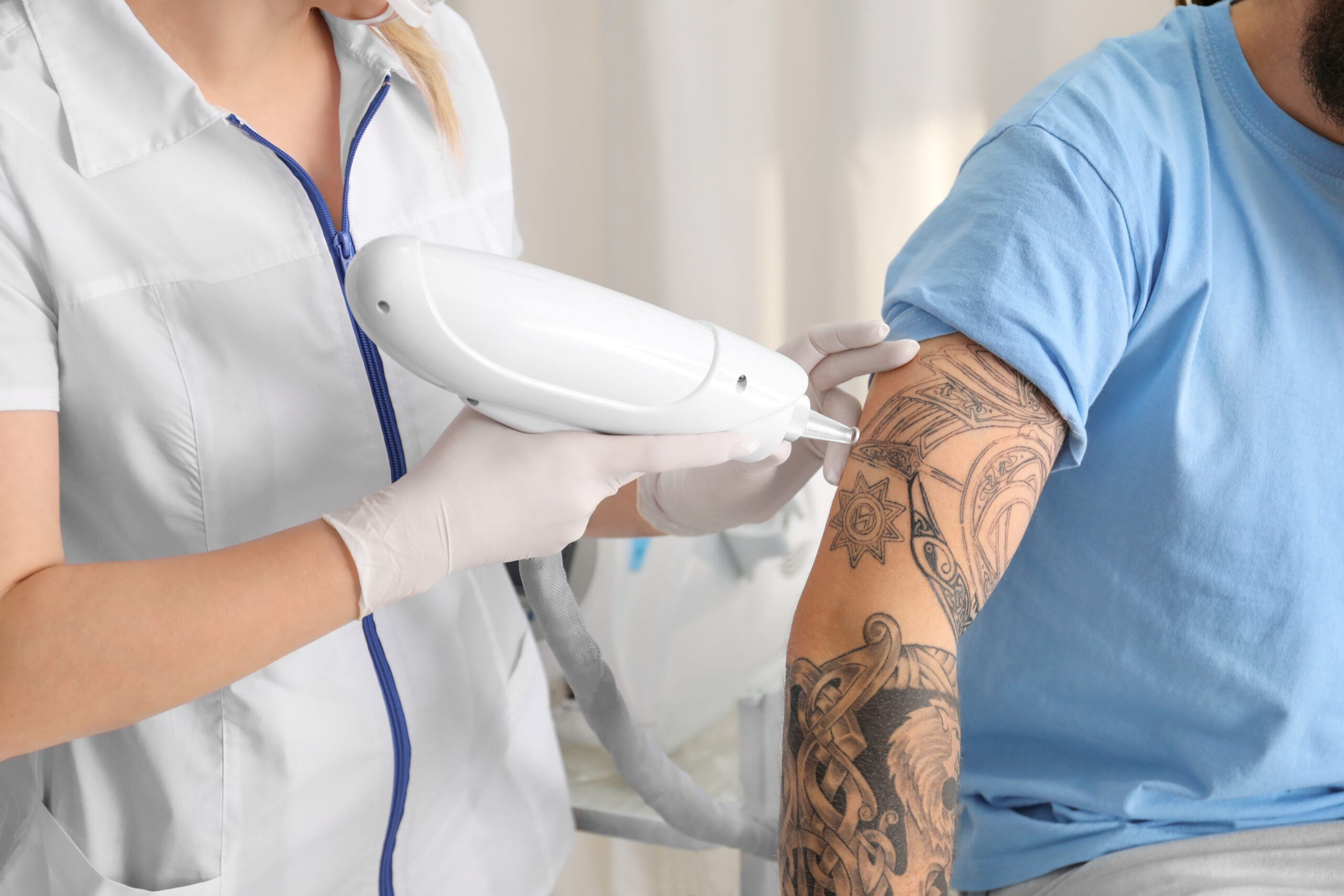 Permanent Tattoo Removal Surgery in Kerala - Cosmetiq Clinic