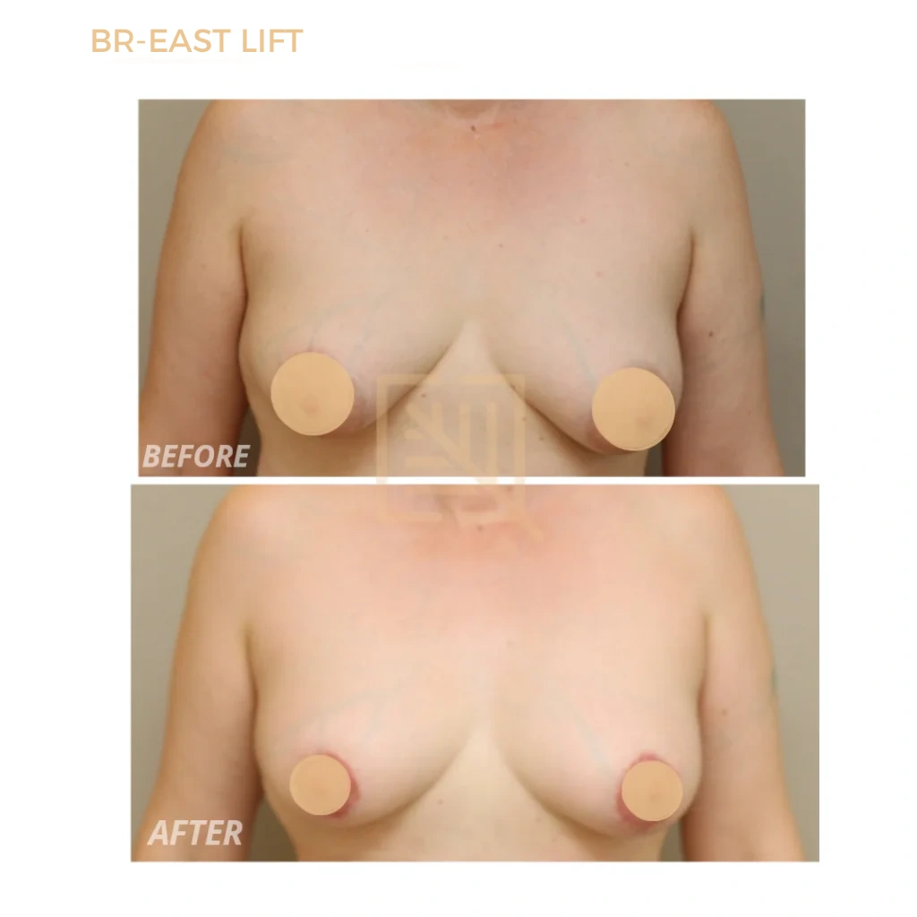 br-east lift before and after