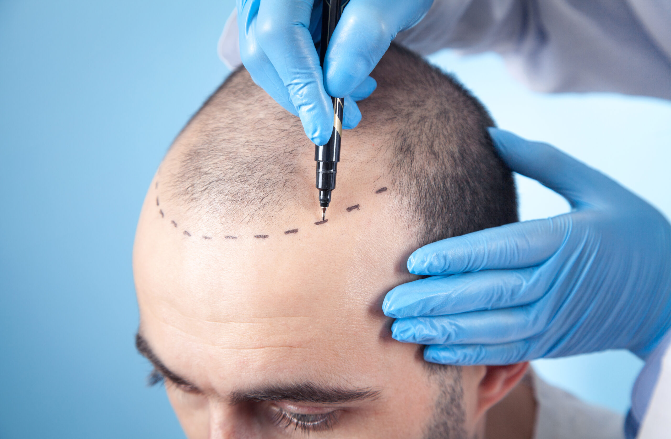 Методы пересадки волос. DHI трансплантация волос. Трансплантация волос в Турции.