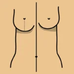 Verticle Br-east-Reduction
