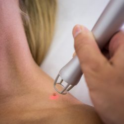 Dermatologist removing mole from womans shoulder with medical laser