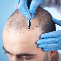 Patient suffering from hair loss in consultation with a doctor. Doctor using skin marker